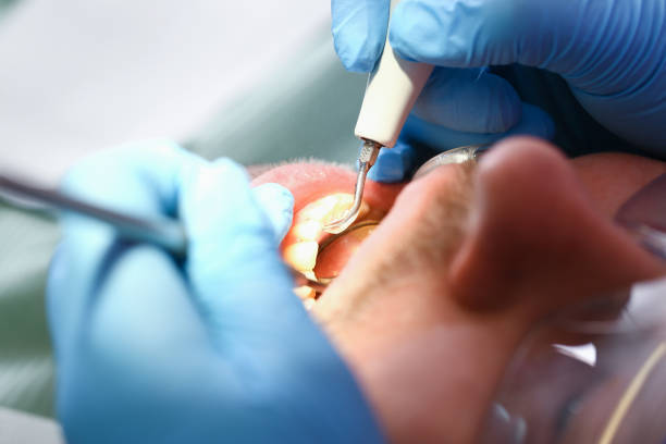 Best Emergency Tooth Extraction in Bellevue, WI